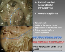 Tricuspid valve anomalies image