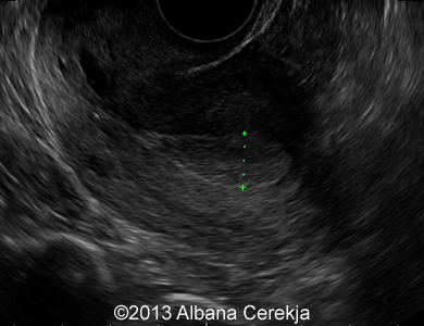 01-endometrium