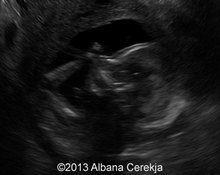 Hemivertebra, 17 weeks image