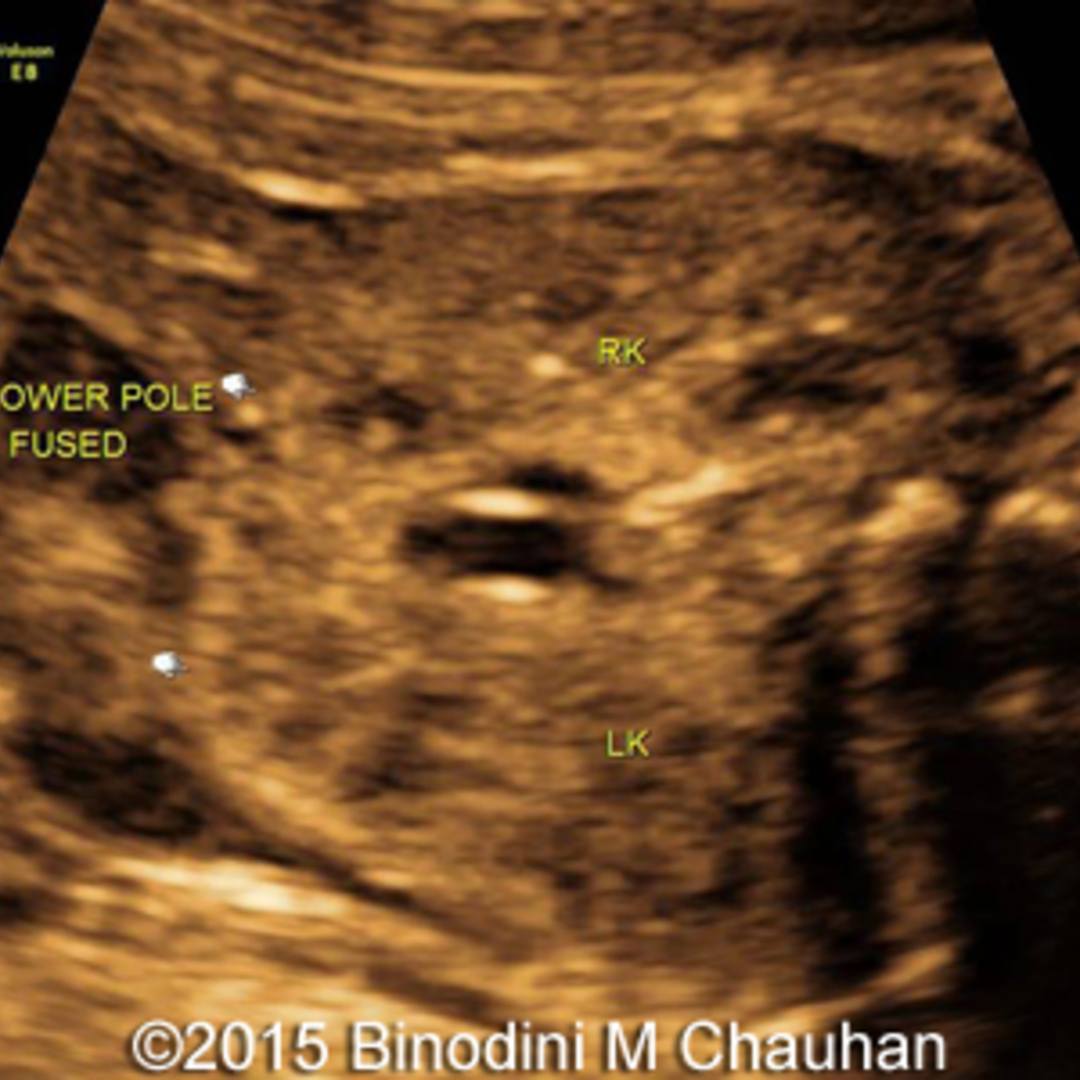 📃 Horseshoe kidney