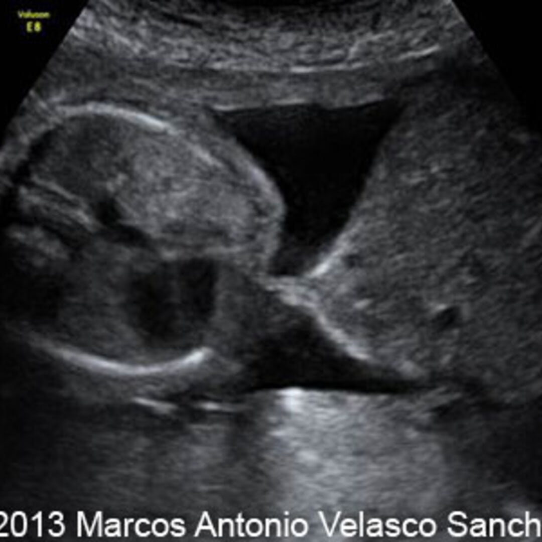 📃 Gastroschisis, large, 24 weeks