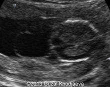 Meckel Gruber syndrome: review of three cases at different gestation age image