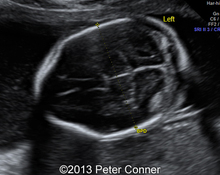 Spina bifida, twin pregnancy image