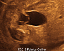 Ureterocele image