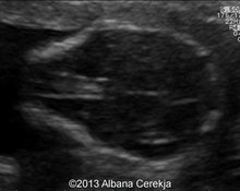 Spina bifida, lumbo-sacral, 16 weeks image