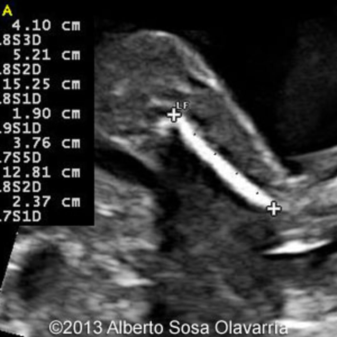 📃 Partial molar pregnancy with normal diploid fetus