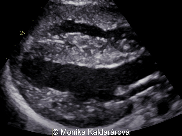 Postnatal image of the heart obtained a couple of days after delivery showing concentric cardiomyopathy.