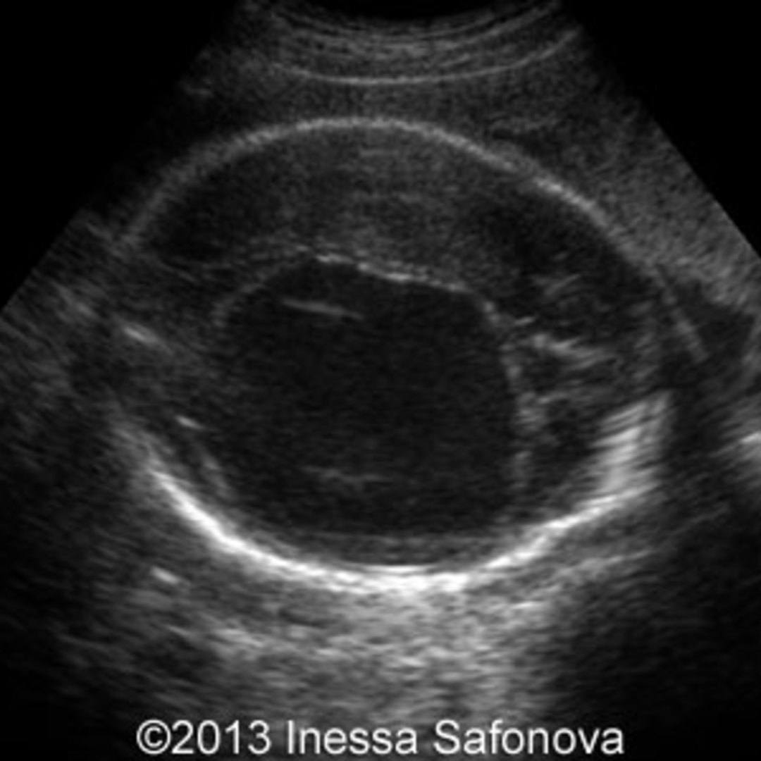 📃 Giant fetal brain cyst with good perinatal result