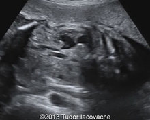 Ureterocele image
