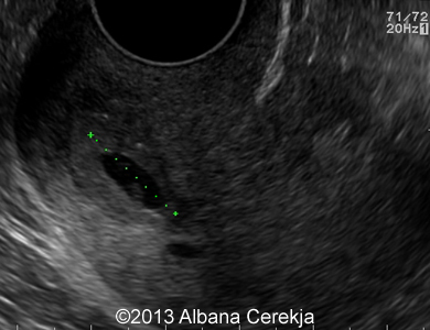 02-gestational-sac