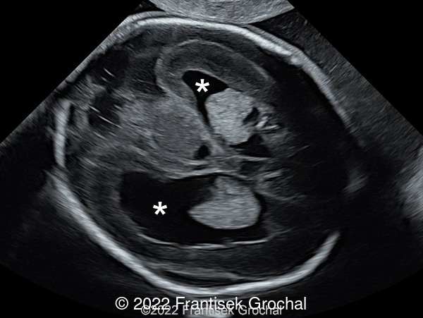 Transverse scan of the fetal head showing enlarged lateral ventricles (asterisks)