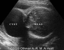 Cervical lymphangioma image