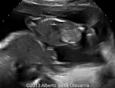 📃 Partial molar pregnancy with normal diploid fetus