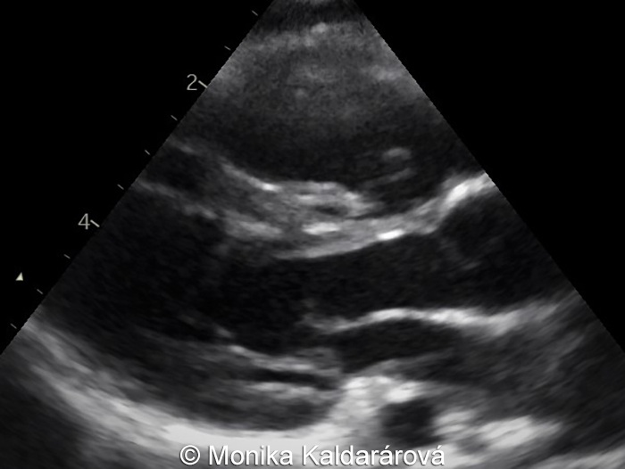 Postnatal image of the heart obtained 10 months after delivery showing enlarged heart but with normal appearance of the ventricular and septal musculature.