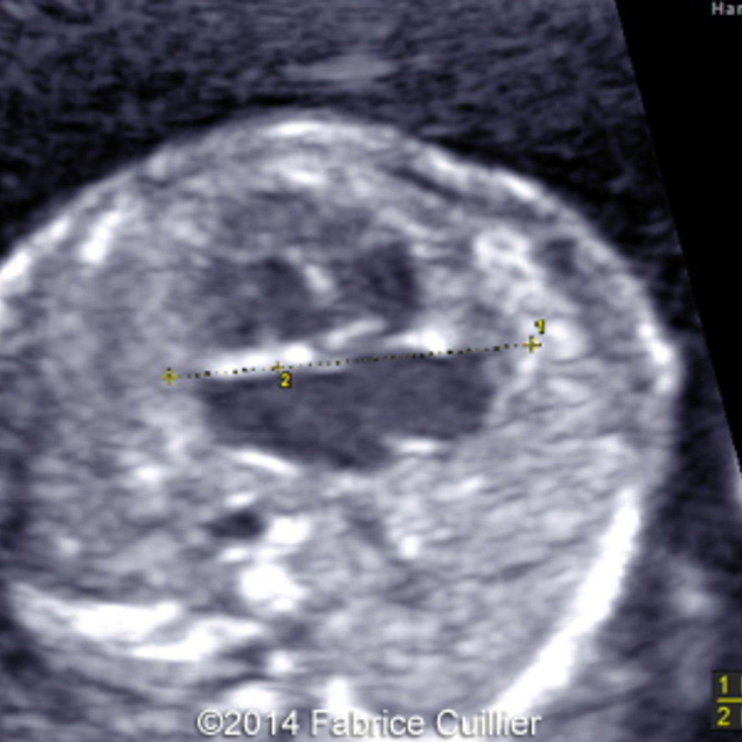 Fetal Alcohol Syndrome The Hidden Clue In Your Child S Ears - bq87dix