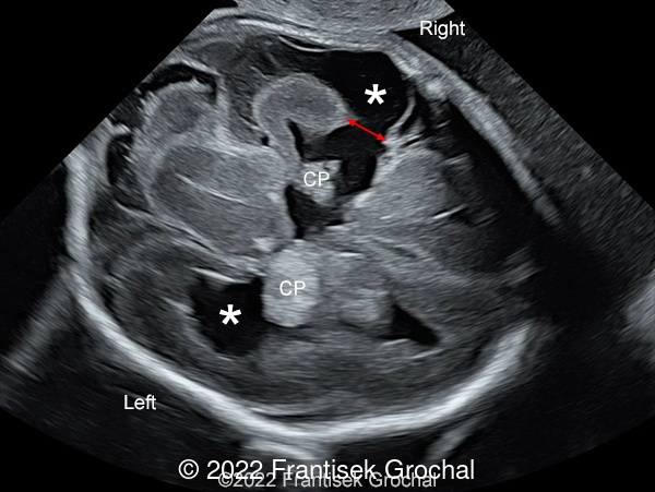 Transverse scan of the fetal head showing enlarged lateral ventricles with striking defect in cerebral mantle on the right side (double-ended red arrow). CP - choroid plexus. Asterisk - cerebrospinal fluid.