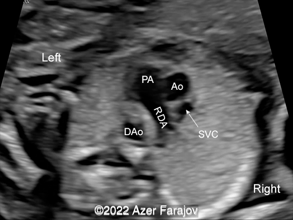Three-vessel-trachea view of the heart showing pulmonary artery (PA), RIGHT DUCTUS ARTERIOSUS (RDA), ascending aorta (Ao), superior vena cava (SVC), descending aorta (DAo)