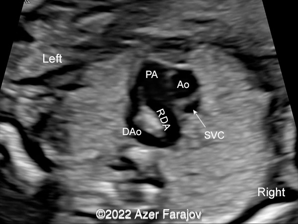 Three-vessel-trachea view of the heart showing pulmonary artery (PA), RIGHT DUCTUS ARTERIOSUS (RDA) making a vascular sling around trachea and connecting to the descending aorta (DAo), ascending aorta (Ao), superior vena cava (SVC)