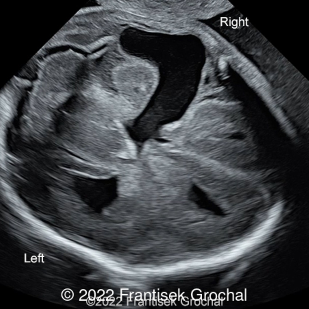 fetal porencephaly