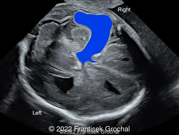 Transverse scan of the fetal head showing striking defect in cerebral mantle on the right side, filled with cerebrospinal fluid (depicted in blue), connecting right lateral ventricle with meningeal surface – open-lip schizencephaly