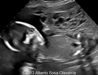 📃 Partial molar pregnancy with normal diploid fetus