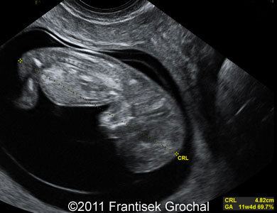 trisomy 21 ultrasound