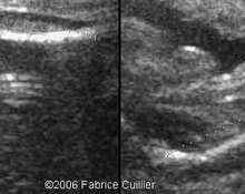 Unilateral femoral hypoplasia image