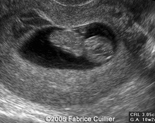 Heterotopic pregancy with intra-uterine twins image