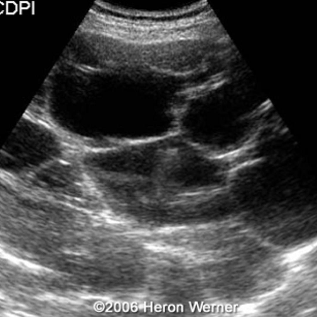 📃 Multicystic liver disease and pregnancy