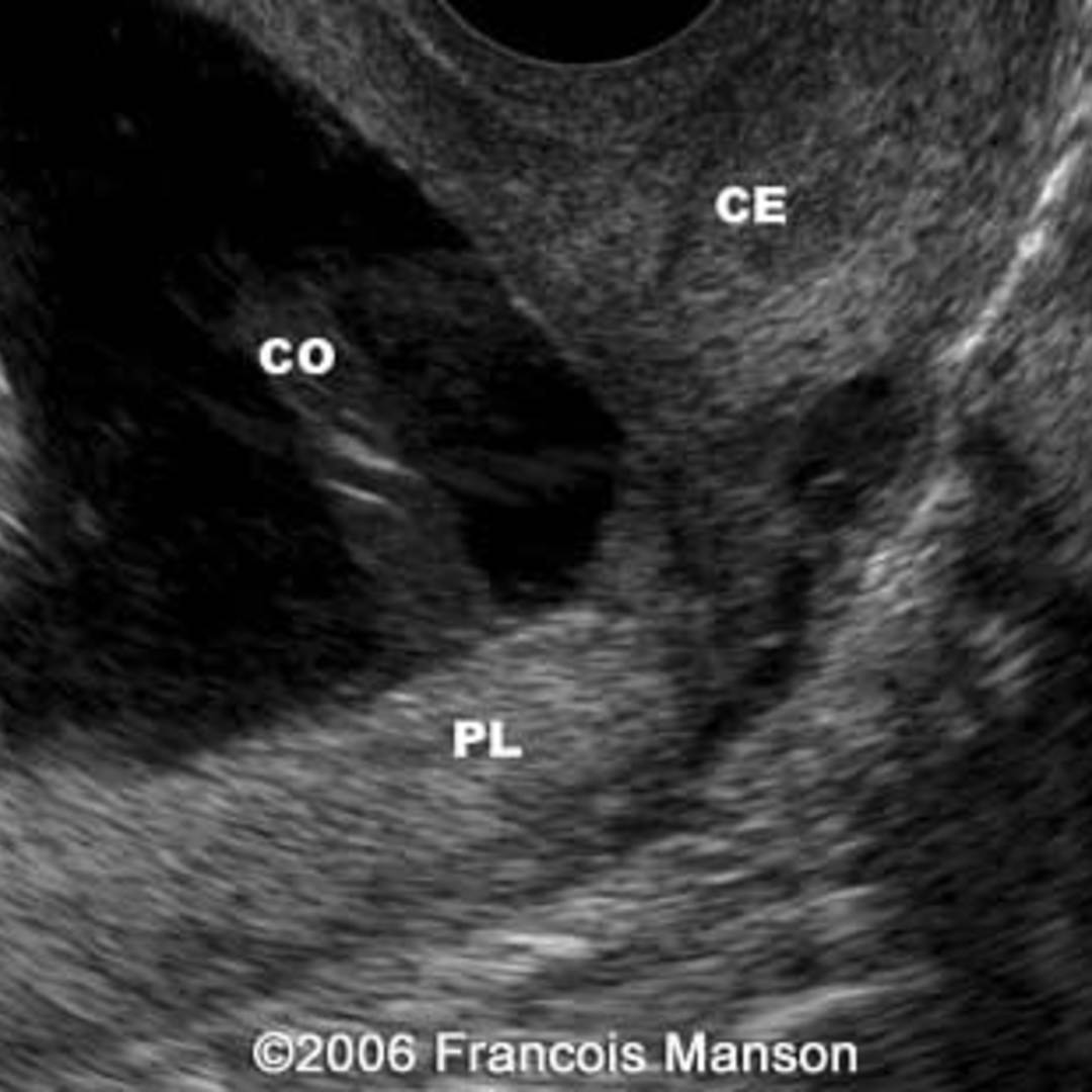 Cord Eccentric Insertion cord-eccentric-insertion