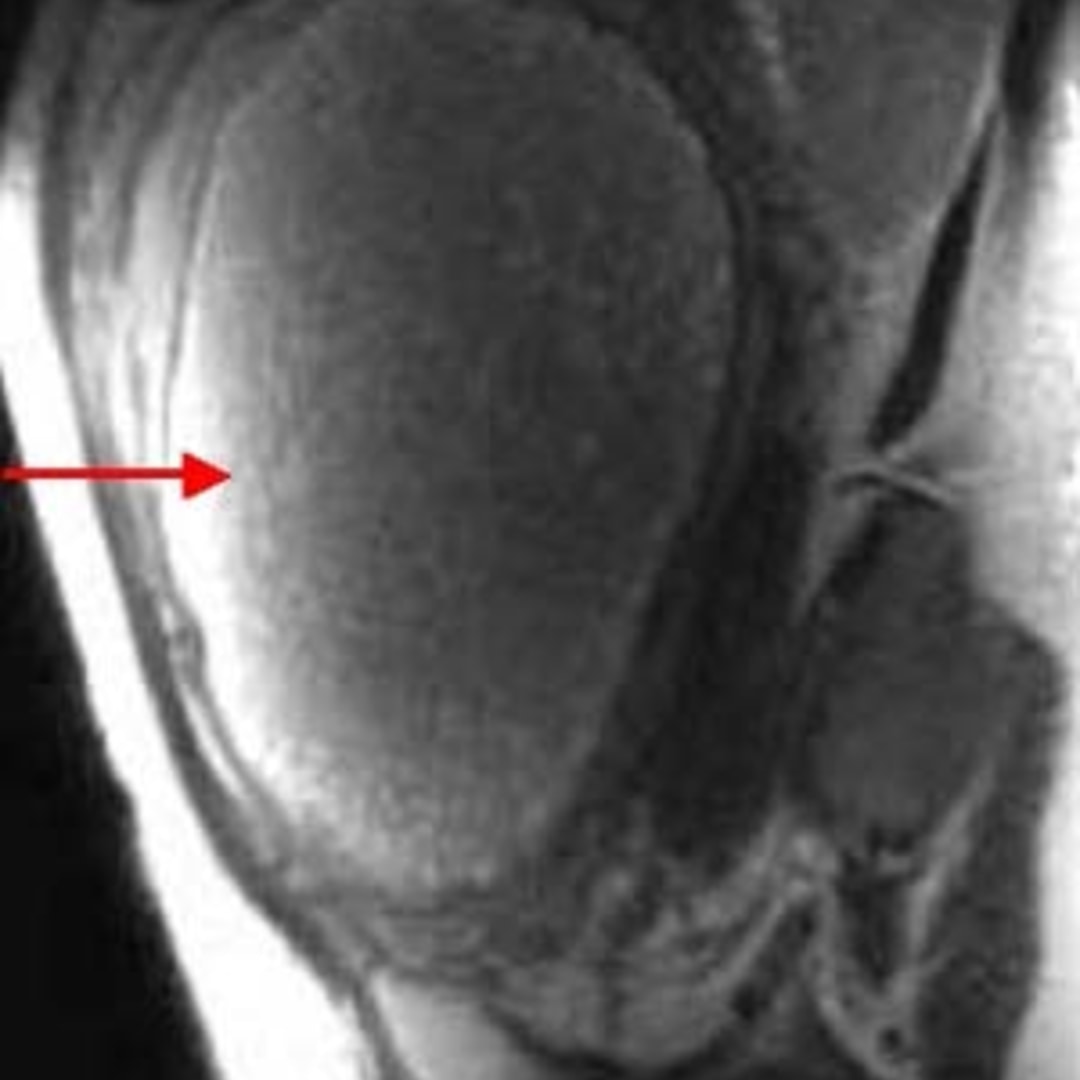 📃 Molar pregnancy
