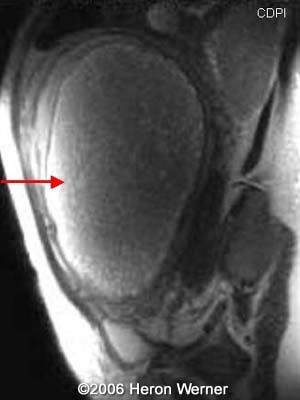 📃 Molar pregnancy