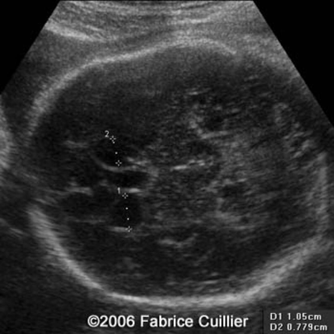 📃 Idiopathic subependymal pseudocyst