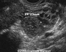 Ectopic pregnancy with negative serum hCG level image