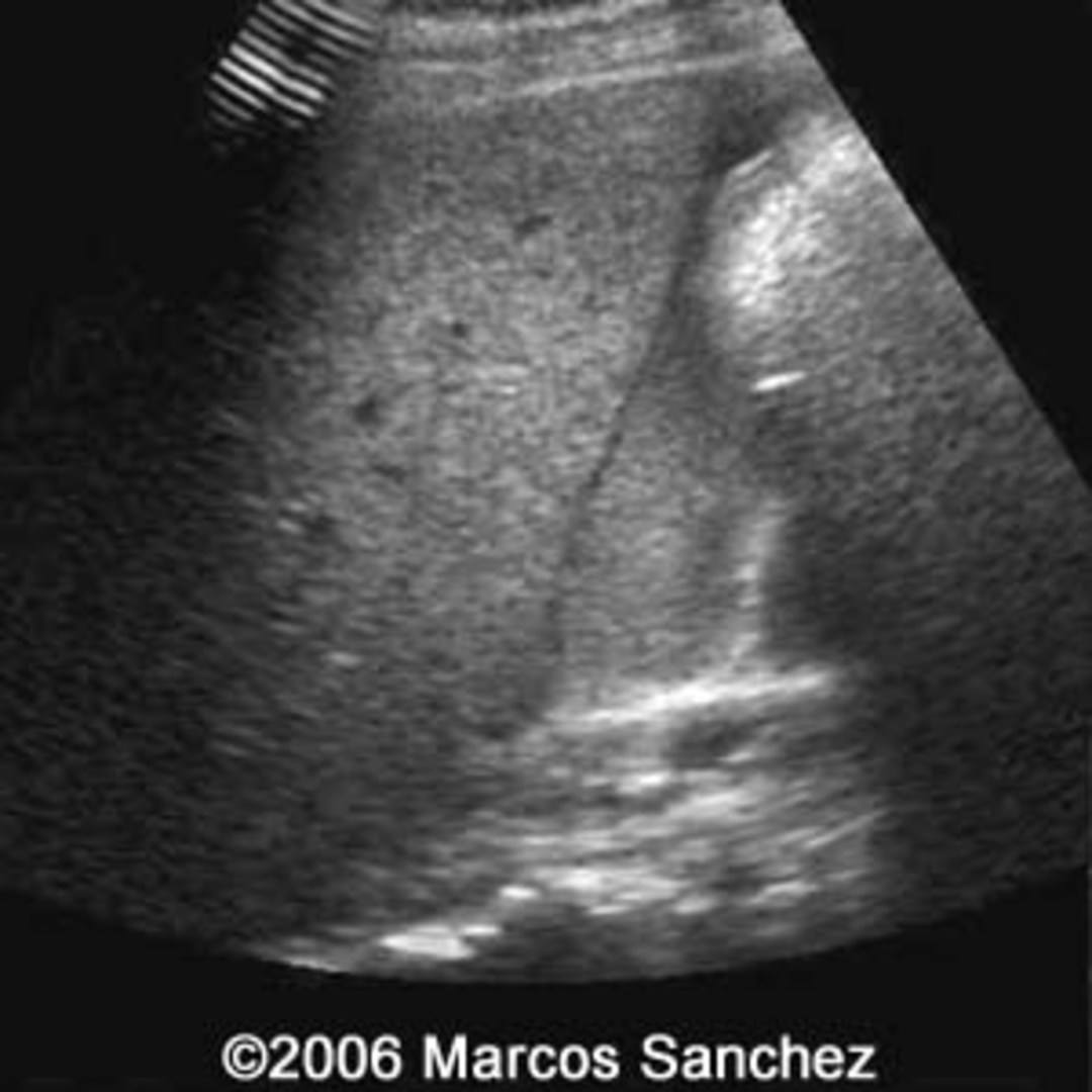 📃 Rudimentary horn pregnancy