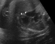 Fetal valproate syndrome image
