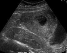 Pelvic kidney image