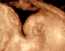 Twins, conjoined, duplicata incompleta dicephalus image