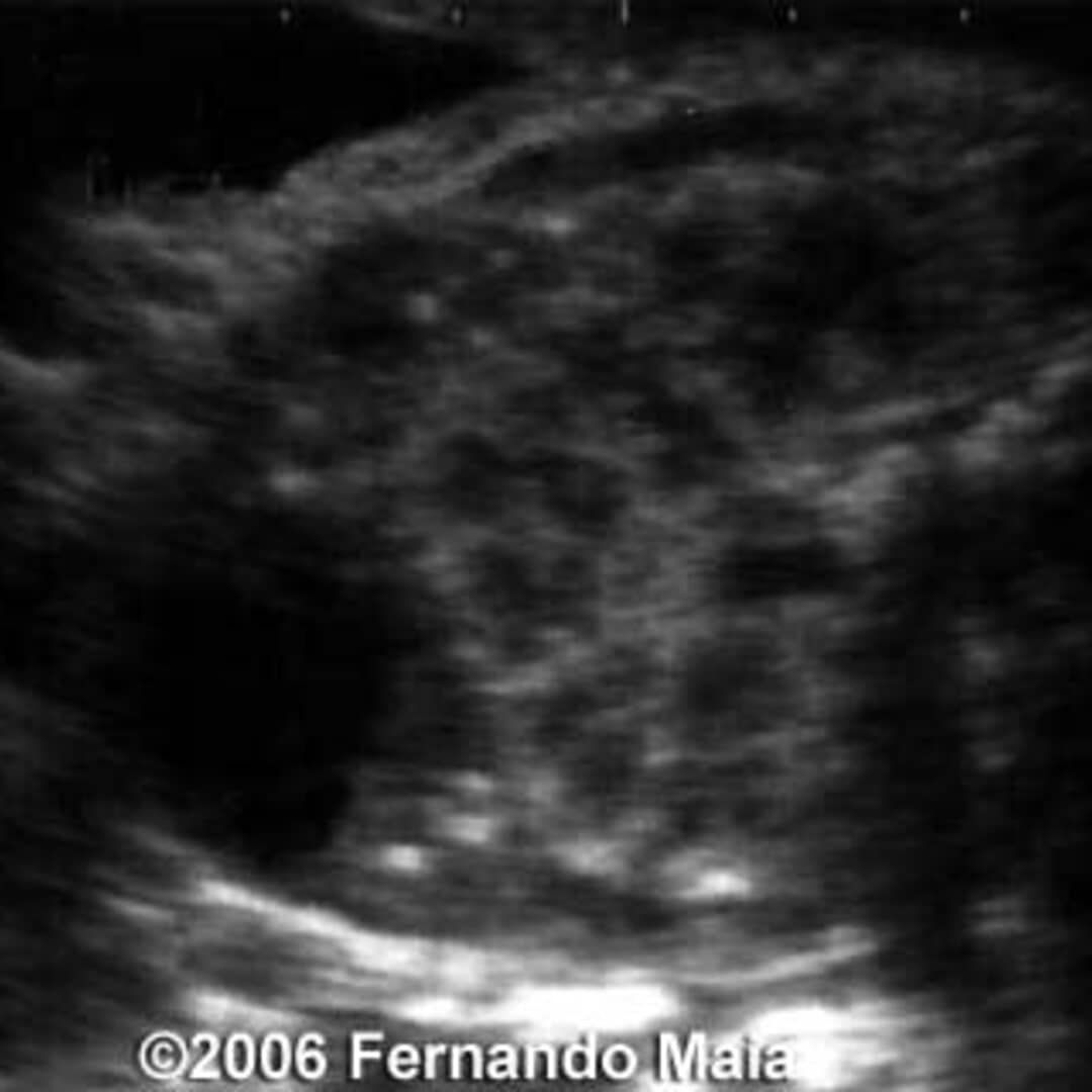 📃 Horseshoe kidney