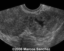 Ectopic pregnancy, left uterine tube image