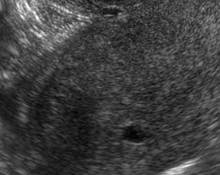 Ectopic pregnancy, cornual image