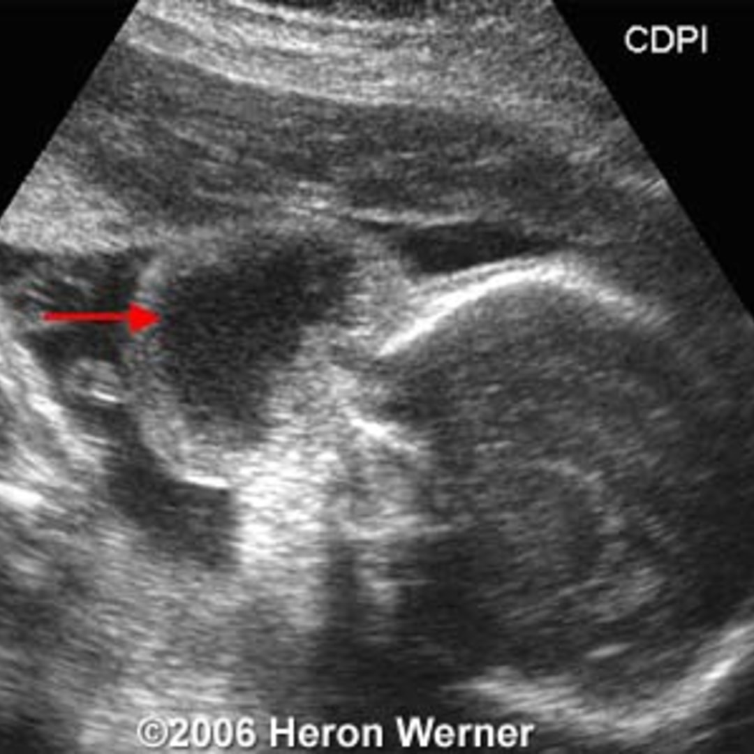 Cephalocele Anterior cephalocele-anterior