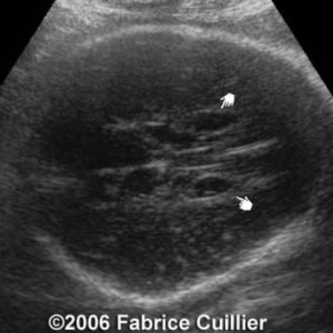 📃 Idiopathic subependymal pseudocyst