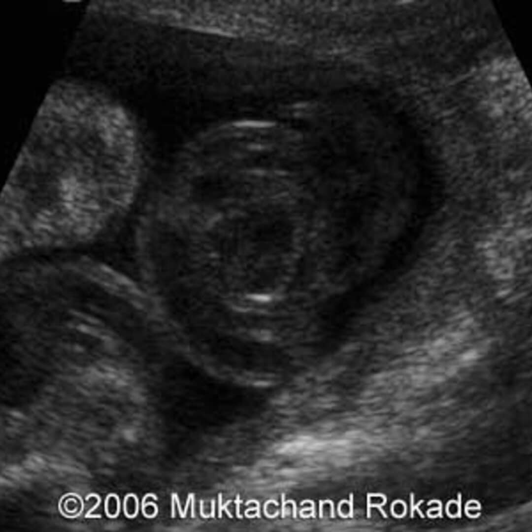  true umbilical cord knot