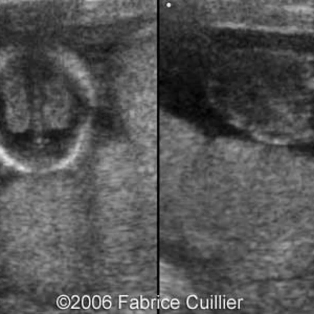 📃 Acrania in one fetus of dichorionic pregnancy