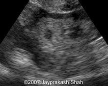 Extrauterine pregnancy, right uterine tube image