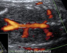 Right kidney agenesis with rudimentary ectopic kidney image