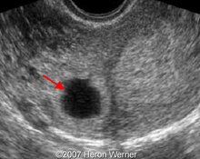 Ectopic tubal interstitial pregnancy image