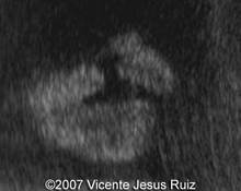 Cleft lip and palate, unilateral image