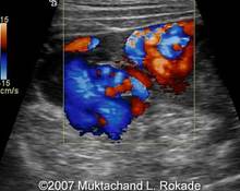 Pelvic varices during pregnancy image